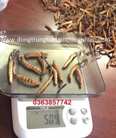 U xơ 8 năm g&acirc;y thiếu m&aacute;u, phải cắt tử cung
