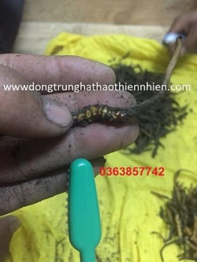 Khối u sau gáy to như đầu người, bệnh nhân tự điều trị suốt 16 năm.